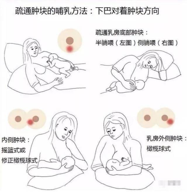 產(chǎn)后漲奶，疼痛難忍怎么辦？