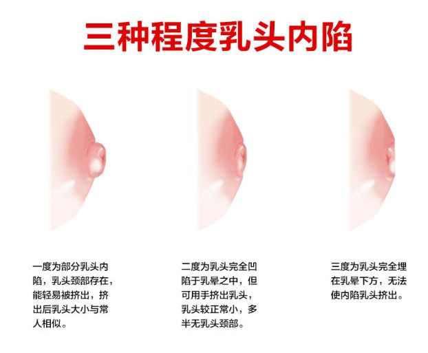 乳頭凹陷的媽媽該如何哺乳？