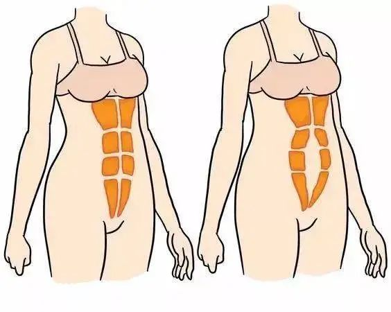 你的腹直肌分離了嗎？一步就知道