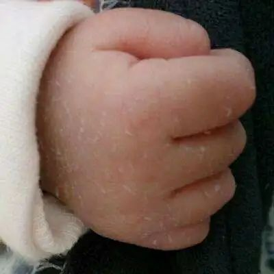 新生兒脫皮是正常的嗎？