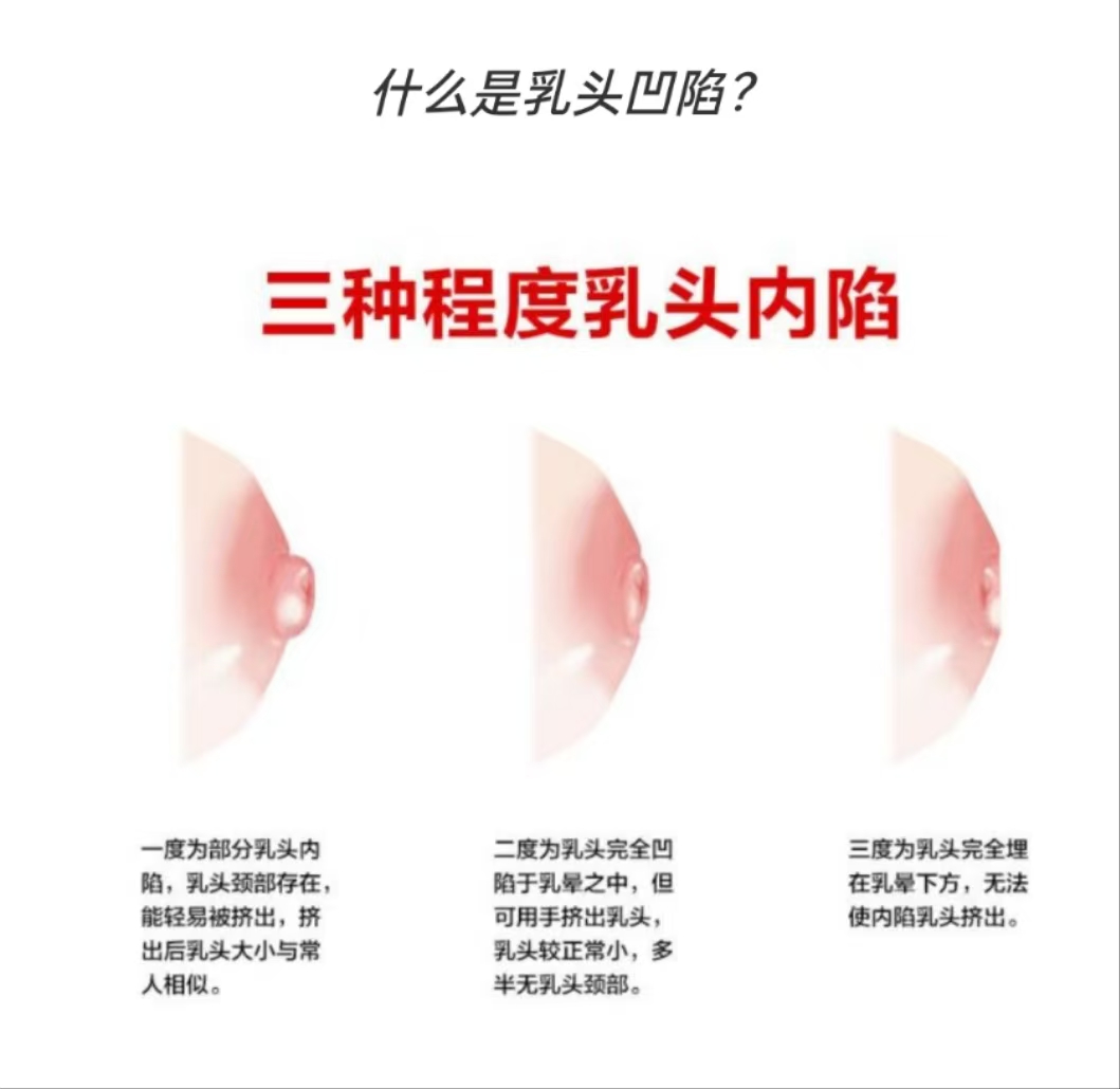 乳頭凹陷的媽媽該如何哺乳？