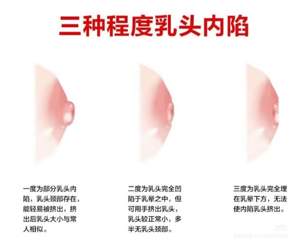 乳頭凹陷的媽媽該如何哺乳？